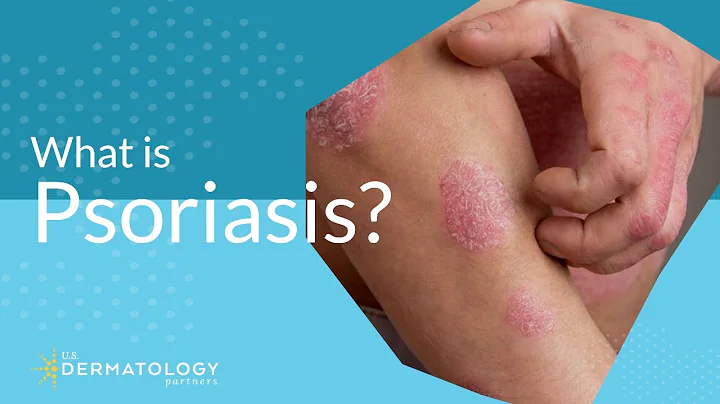 What Is Psoriasis?