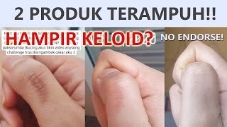 3 DAYS CHALLENGE - JERAWAT TAMAT 3 HARI AJA?? REALLY?? | PONDS ACNE SOLUTION | IRNA DEWI