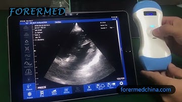 wireless Ultrasound