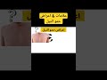 علامات اعراض حمو النيل     حمو النيل