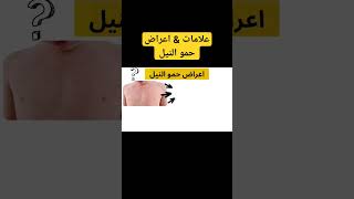 علامات & اعراض حمو النيل #ahmed_pharmacy #fypシ #viral #حمو_النيل