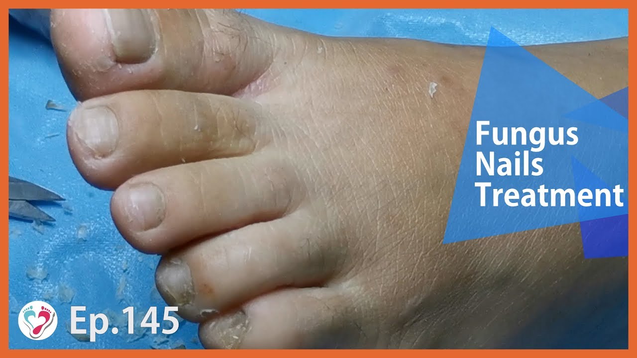 TOP MEDICAL PEDICURE Ep.145 Fungus Toenail Explained and Treatment