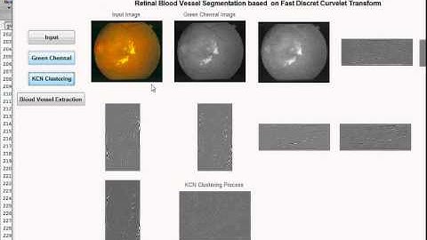 Blood Vessel Extraction for retinal images using morphological operator and KCN clustering