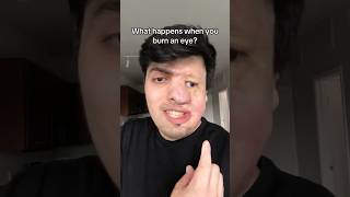 What Happens When You Burn An Eye
