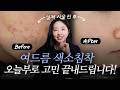 여드름 자국, 이렇게 달라집니다ㅣ전후 사진으로 확인하세요!