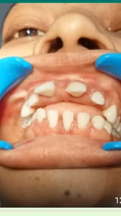 close teeth spaces with braces #shorts #youtubeshorts #shots #treatment #orthodontics #braces#love