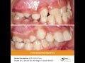 Ensuring Your Child's Bright Smile: Orthodontic Solutions for Common Dental Concerns