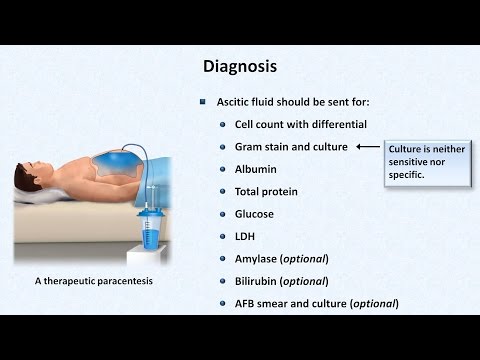 Spontaneous Bacterial Peritonitis