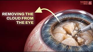 How Cataract Surgery Works