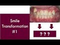 Smile Transformation #1  |  Dr. Jiten Vadukul  |  The Orthodontist