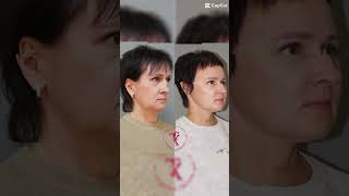Эндоскопия лба и #smas лифтинг лица и шеи. Результат через 4 года #омоложениелица #качановахирург