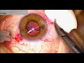 Minimally invasive surgery for dislocated intraocular lens the cupid fixation stepbystep