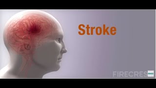 FIRECREST Medical Animations: Stroke