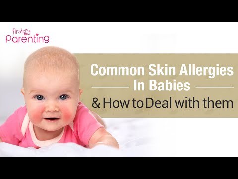 Video: How To Relieve Allergic Itching In Babies