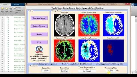 Early Brain Tumor Detection Matlab Project Source Code