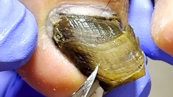 Black Bad Nails Are Like Hard Shells! Cut Them Thoroughly【Xue Yidao】