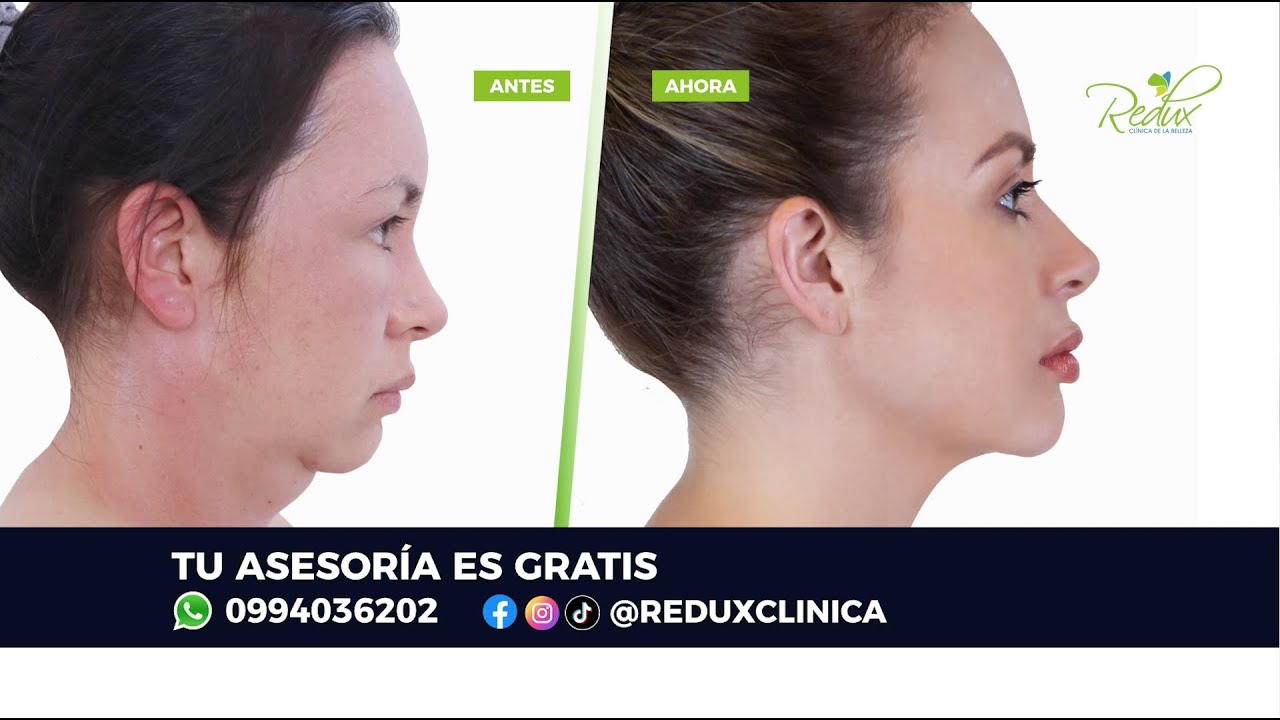 Cómo eliminar la papada y los cachetes? Con una lipofacial en