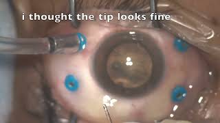 Vitrectomy: chandelier: lesson learn