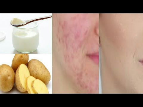 Potato skin whitening + dark spots + Acne Remedy in Urdu // Beauty Tips with FATIMA