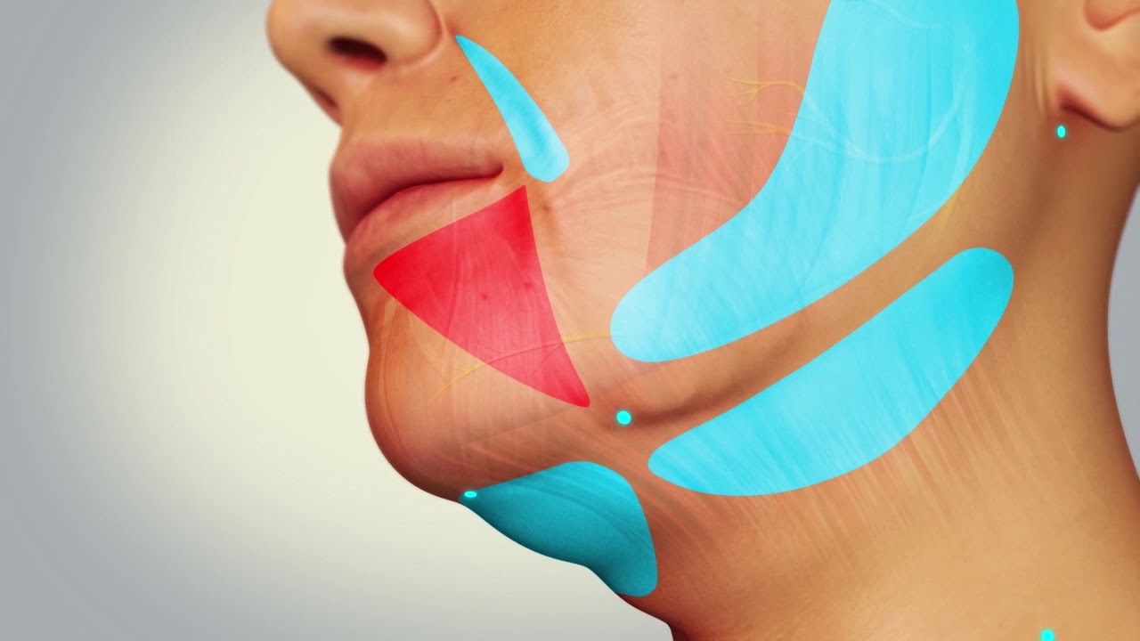 Learn How AccuTite Works