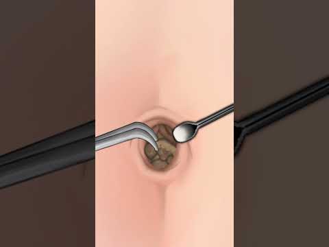 ASMR |  Navel Stone  Belly Button Ring Remove Animation