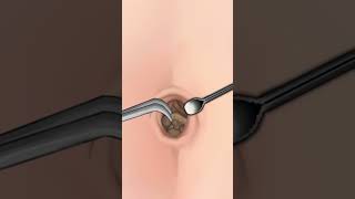 ASMR |  Navel Stone  Belly Button Ring Remove Animation screenshot 4