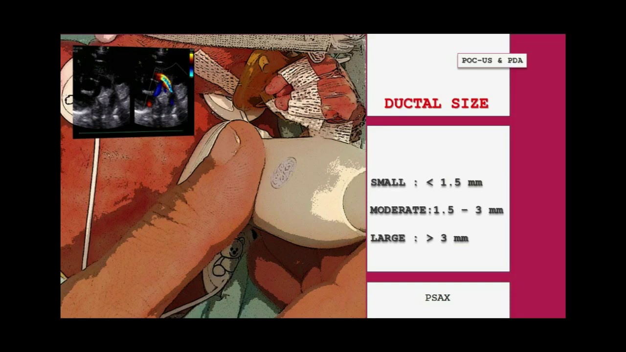 ECHOCARDIOGRAPHIC EVALUATION OF PATENT DUCTUS ARTERIOSUS.