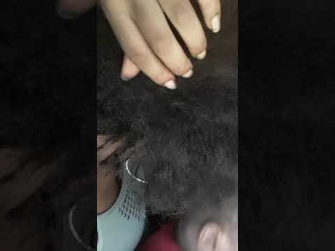 Picking scalp...impetigo������ - YouTube