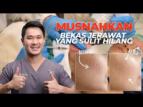 TREATMENT AMPUH UNTUK TIPE JERAWAT ICE PICK SCAR & BEKAS JERAWAT YANG SULIT HILANG!