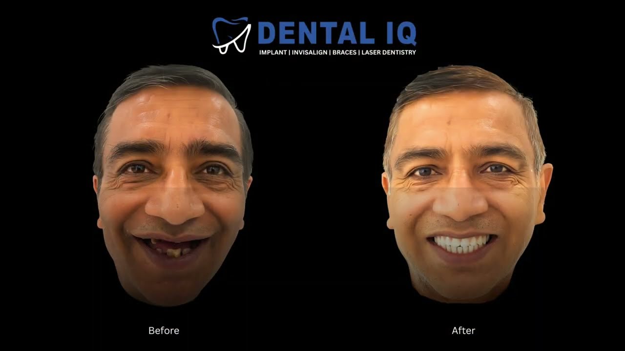 Full Mouth Dental Implants in Mohali and Chd| Case Study by Dr. Ramandeep, Prosthodontist @DentalIQ