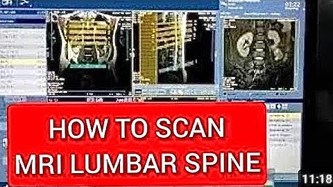 Lumber spine mri scan protocol,positioning and planning | live demo on Canon 1.5 Tesla..​⁠
