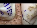 Satisfying Hien Spa Beauty Relaxing Video #101