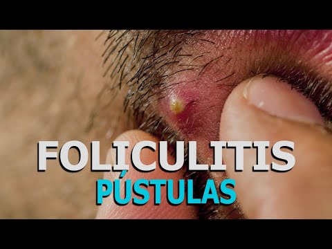 Video: Quitar Granos De Pus En La Cabeza