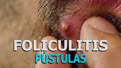 ¿La foliculitis tiene pus?