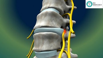 IBS Hospital | Micro Lumbar Discectomy | Precision Surgery for Herniated Disc Relief