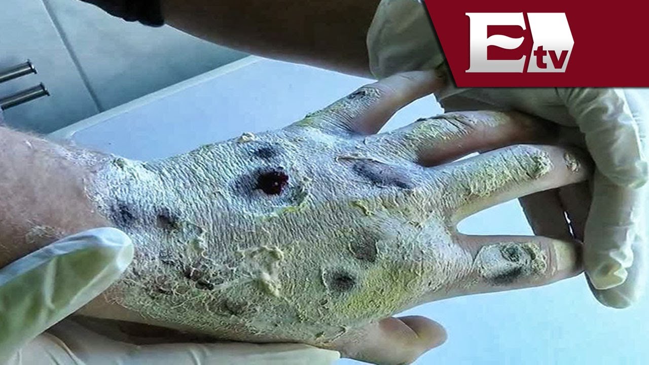 Alerta por casos de droga Krokodil en México / Titulares de mañana - YouTube