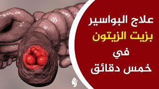 علاج البواسير بزيت الزيتون في خمس دقائق لن تذهب للطبيب بعد اليوم