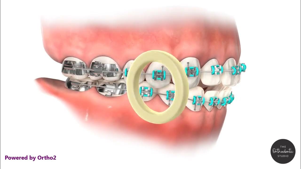 Elastics Triangle Right Side The Orthodontic Studio at Chevy Chase