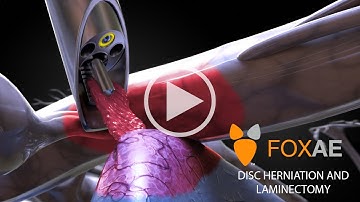 Laminectomy | Legal Animation | Surgery Demonstration