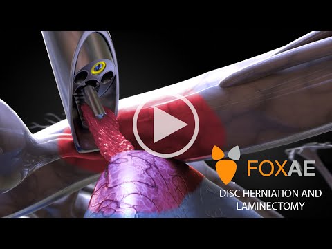 Laminectomy | Legal
