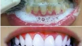 خلطة رهيبة لتبيض الاسنان وإزالة رائحة الفم،من التجربة الأولى