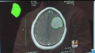 Artificial Intelligence, 'Virtual Biopsies' May Be The Future Of Understanding Brain Tumors