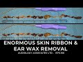 ENORMOUS SKIN RIBBON AND EAR WAX REMOVAL - EP166