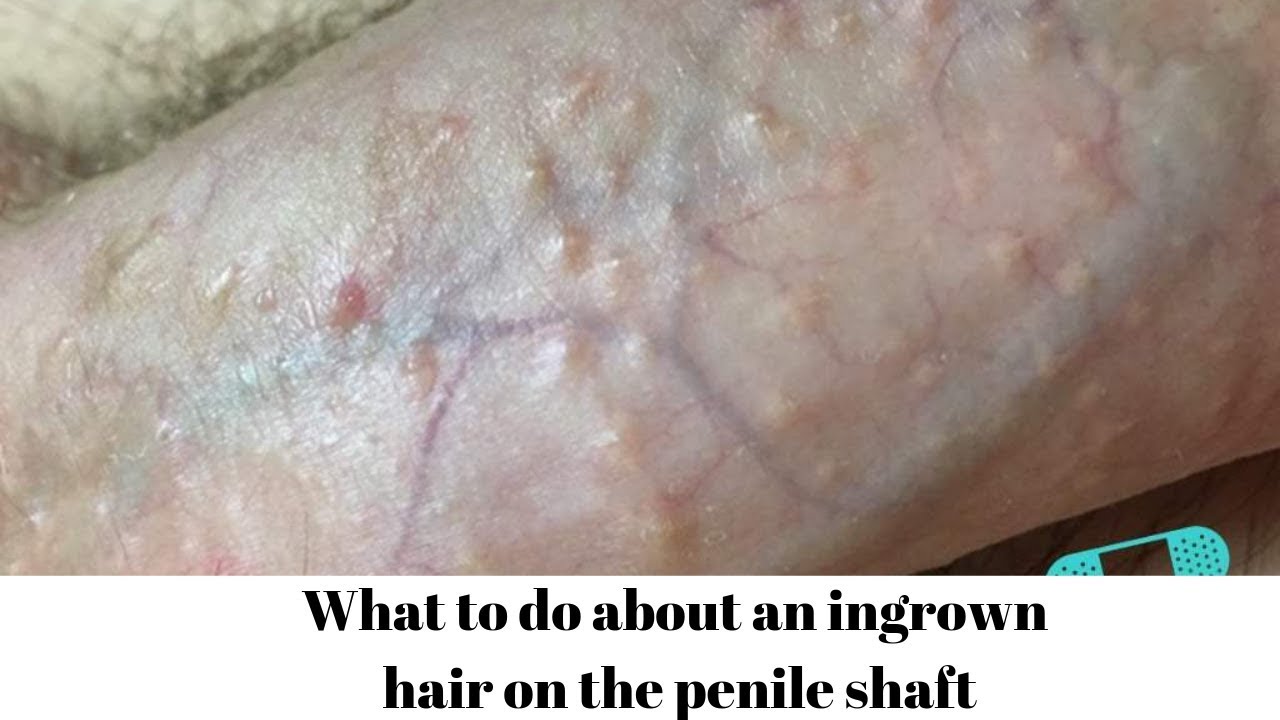 What to do about an ingrown hair on the penile shaft