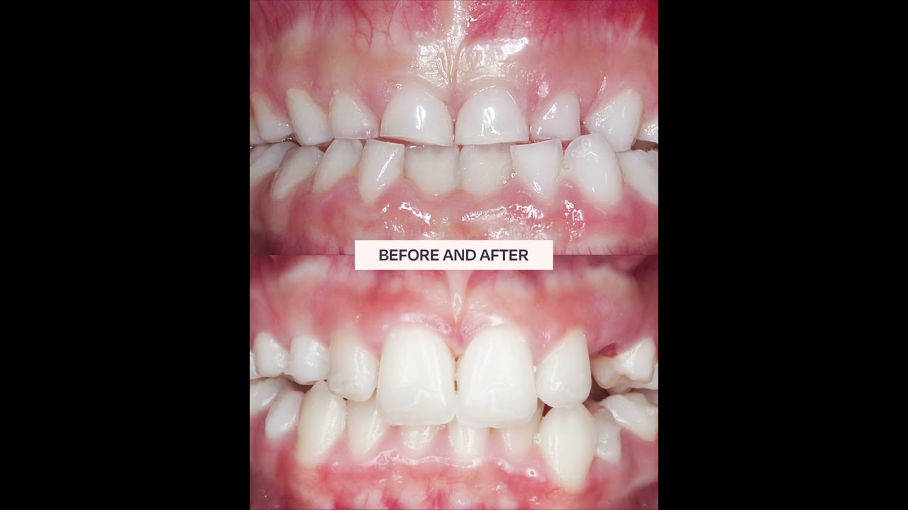  Incredible Before And After From Little Girl To Teenager