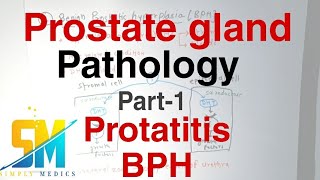 ascites a prosztatitisből chronic prostatitis low testosterone