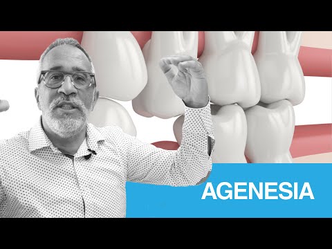 Dente da latte: cosa fare se manca il dente definitivo?