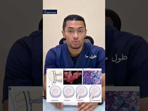 علاج الانزلاق الغضروفي دايما سهل بالعلاج الطبيعي علاج طبيعي الغضروف العلاج التحفظي