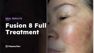 Fusion 8 Full Treatment