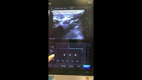 CHOP Mindray TE7 Training Video